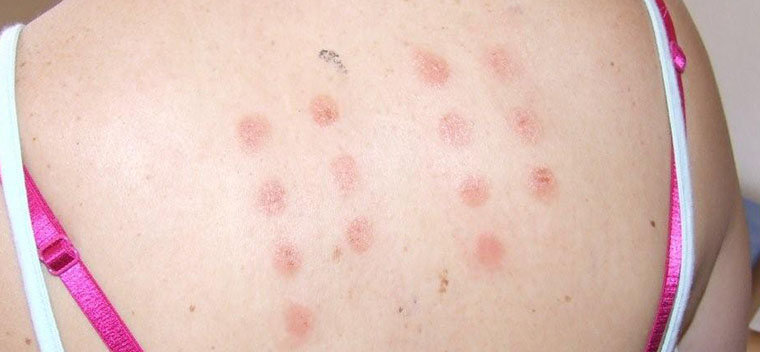 Allergy Skin Patch Testing